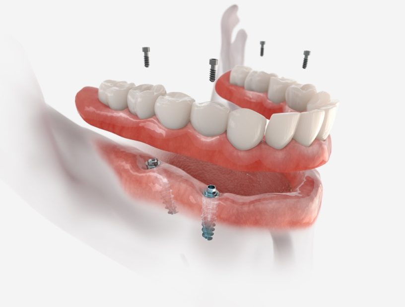 Rebuilding Trust with All-on-4 Dental Implants: An In-Depth Manual